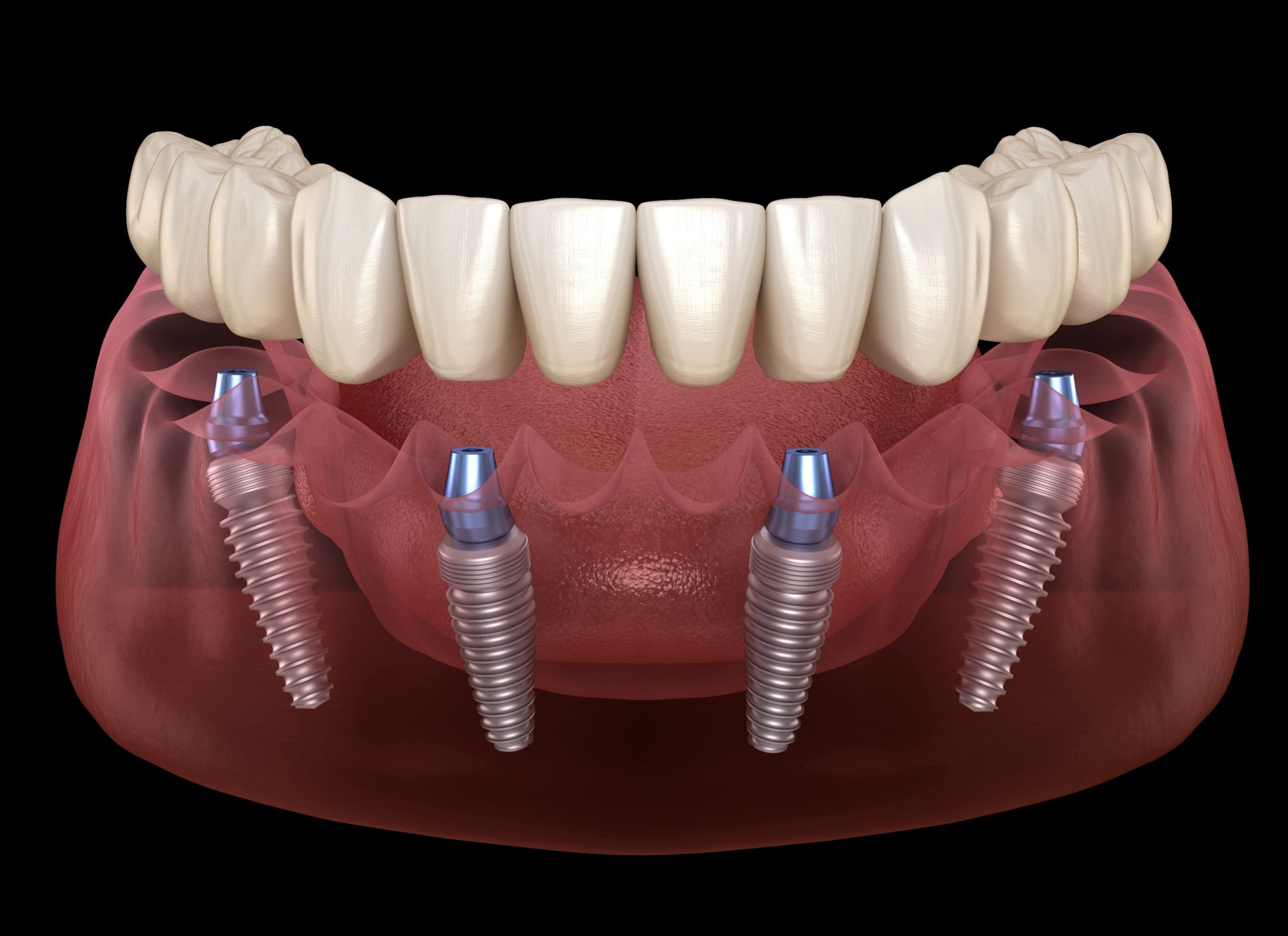 All-on-4 dental implants