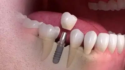 Single dental implant