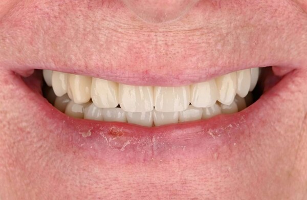 Before dental implants