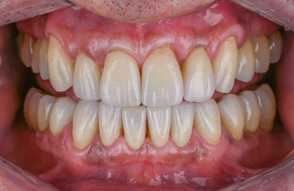 Before dental implants